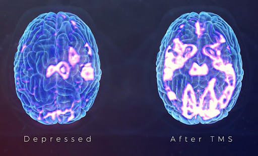 MRI scan of two brains with title "depressed" under left side brain and title "after TMS" under right side brain highlighting reactivation of neurotransmitters through TMS